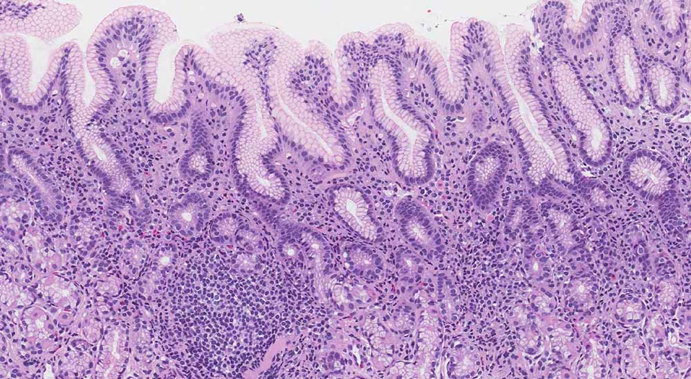 kronični-gastritis